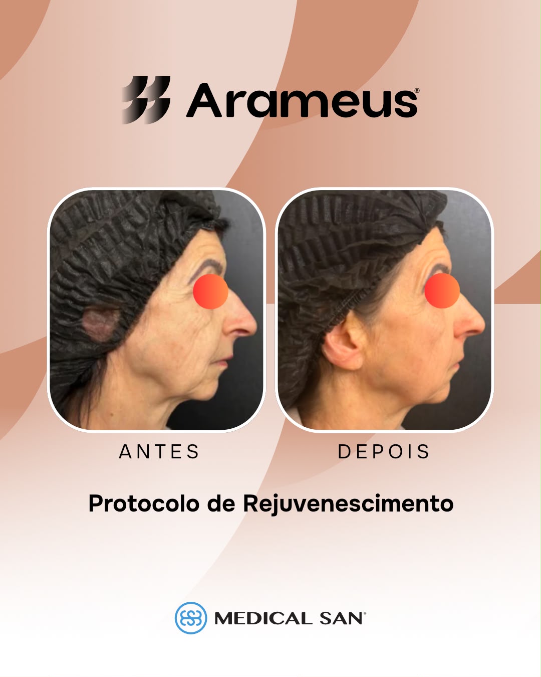 Antes e depois de protocolo de rejuvenescimento