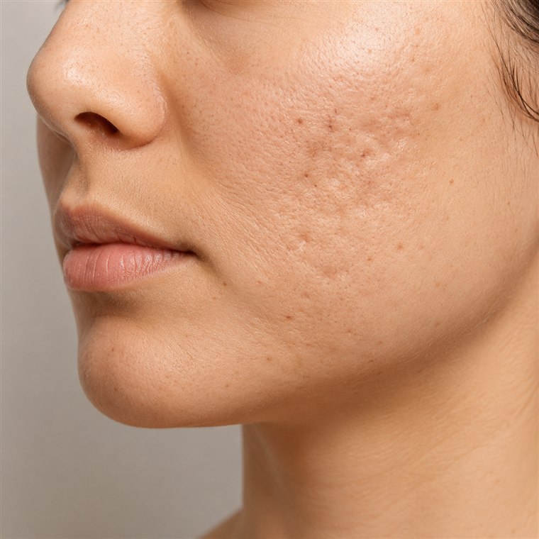 Cicatrizes de acne
