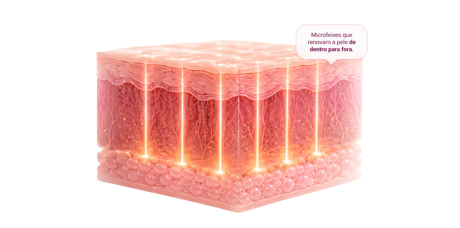 Representação das microzonas de tratamento do Laser Arameus nas camadas da pele